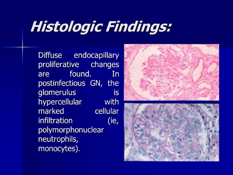 Histologic Findings:  Diffuse endocapillary proliferative changes are found. In postinfectious GN, the glomerulus